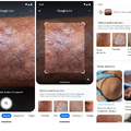 Googleレンズ、肌の状態を写真で「検索」可能に。表現が難しい症状も対応、医療機関への相談を推奨